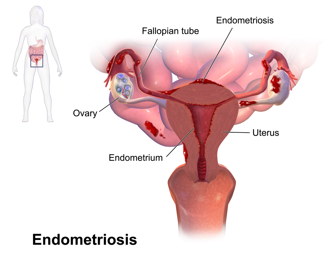 Blausen 0349 endometriosis