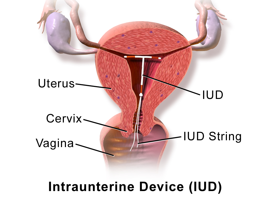 Blausen 0585 iud