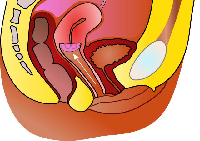 Contraception diaphragme