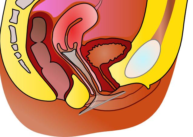 Contraception preservatif feminin